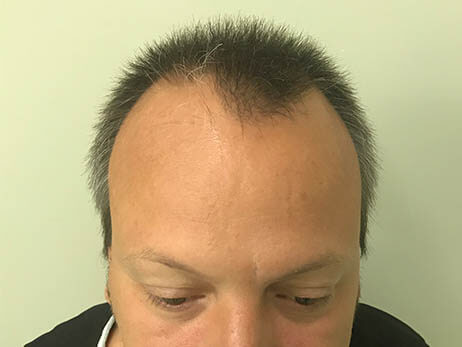 Clinista-hair-transplant-before3