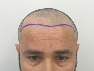 Clinista-hair-transplant-before2