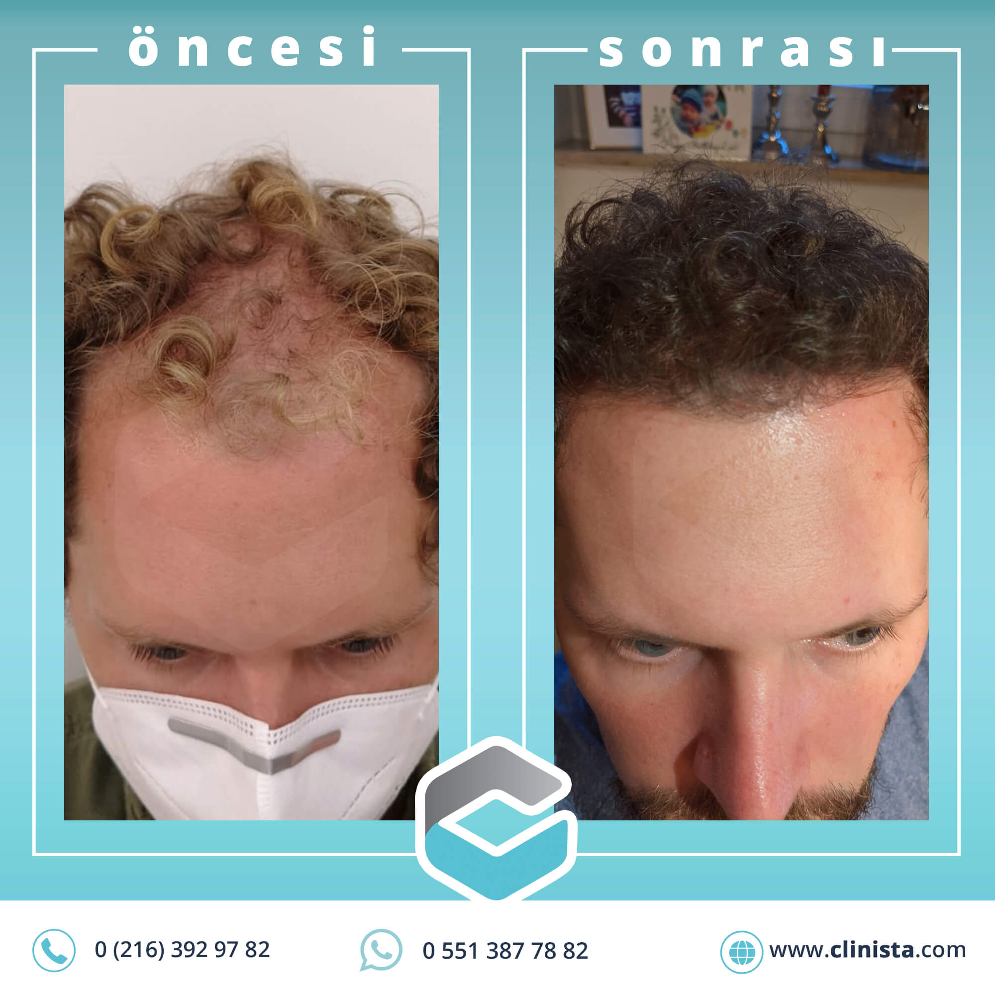 35 year male Result of hair transplant