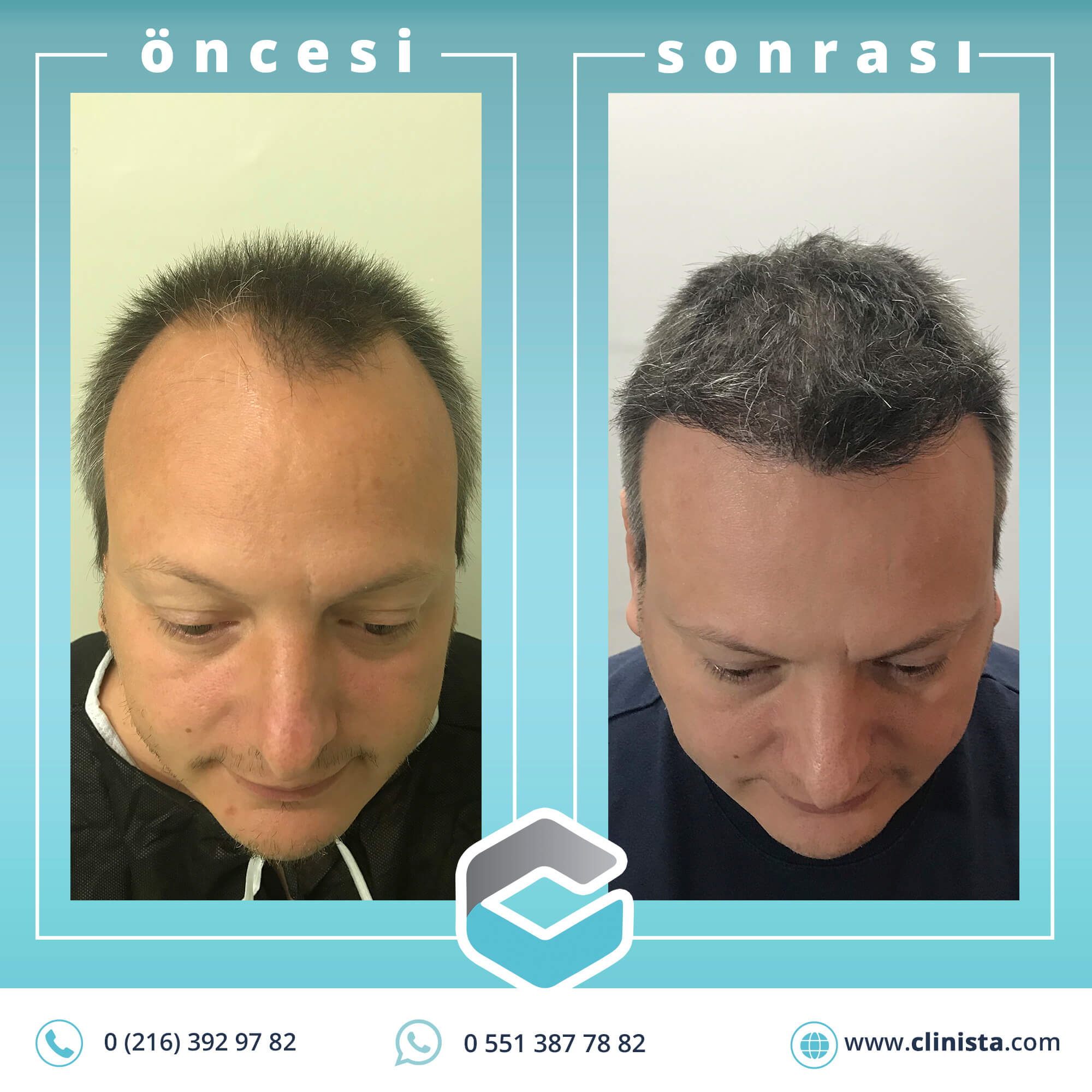 50 year old male result hairline reconstruction