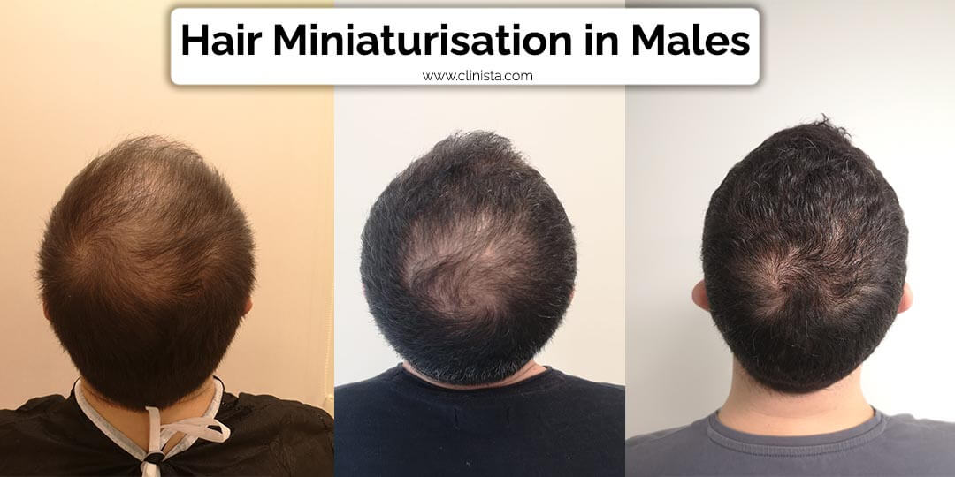 hair miniaturization