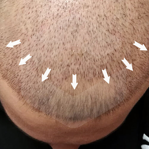 direcktions-frontal-hair-line