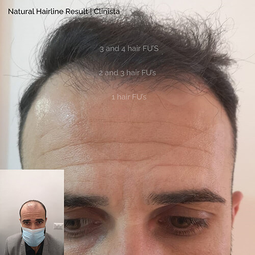 natural-hairline-result-FRONT