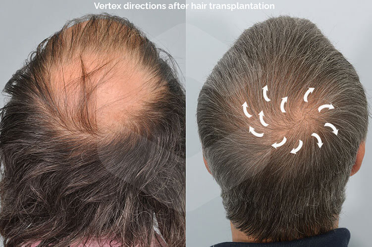 vertex-directions-hair-transplant.