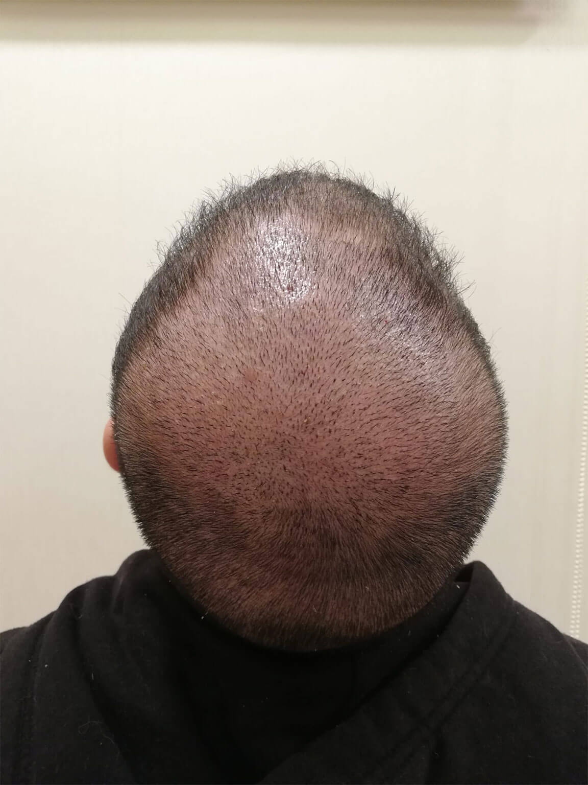 Right after crown hair transplant