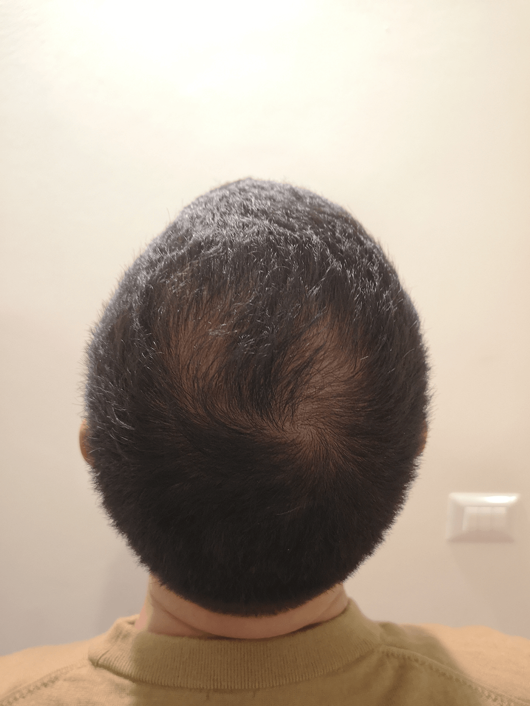 Early Thinning and Hair Loss on Crown Area