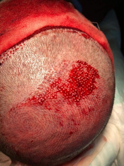 Natural crown hair transplant incisions crown hair transplant