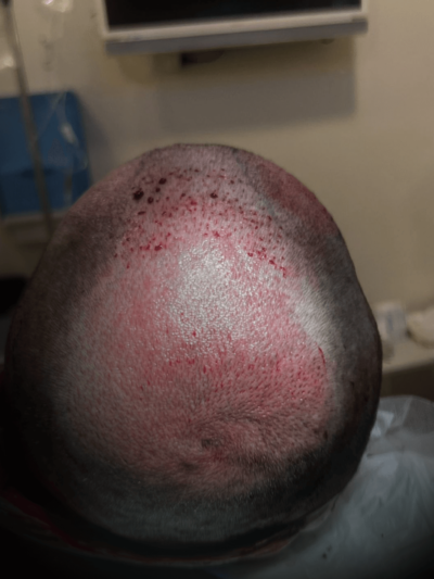 correct crown hair transplant incisions Examples about creation of natural whorl incisions