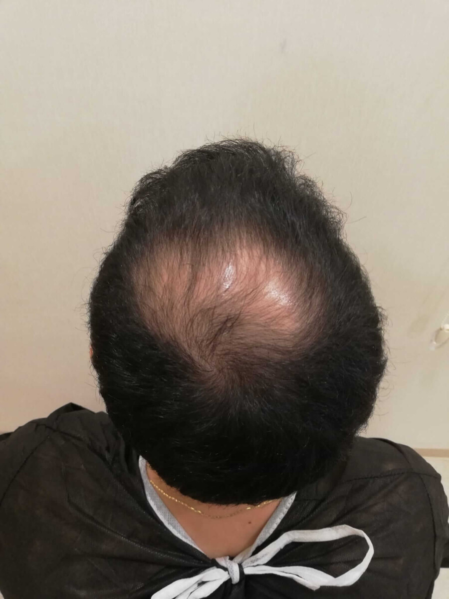 Before crown hair transplant hair loss Before crown hair transplant