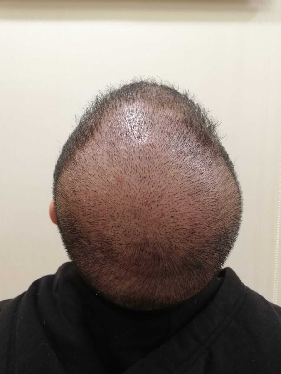 crown hair transplant